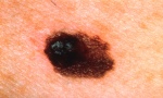Melanoma (festékes bőrrák) mikroszkópikus képe