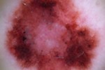 Számítógépes anyajegyvizsgálat (dermatoszkóp fotója) Számítógépes anyajegyvizsgálat (dermatoszkóp fotója)