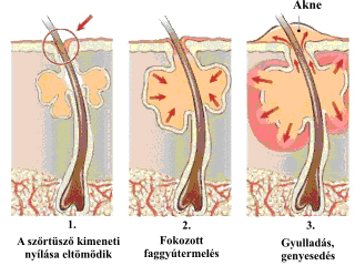 Akne kezelése / Mátyásföld Klinika 2.kep