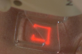 Frakcionált széndioxid nyalábok négyszögletes kezelőfej területén Frakcionált széndioxid nyalábok négyszögletes kezelőfej területén