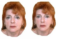 3D kép műtét előtt és az arcplasztika tervezett eredménye 3D-s képen