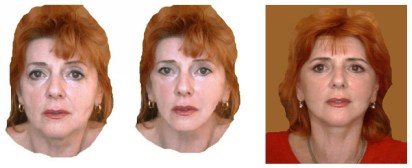 műtét előtti 3D-s kép - tervezett eredmény - arcplasztika utáni 3D-s kép