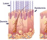 Frakcionált CO2 lézer sugarak behatolása az epidermis rétegbe