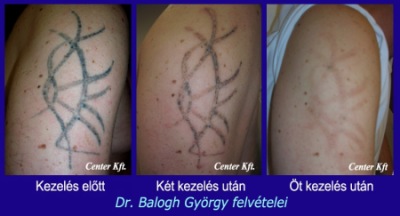 Tetoválás eltávolítása Q-kapcsolt YAG lézerrel/ Dr. Balogh György- Fehérhajó Revital Center