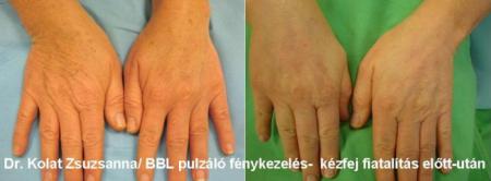 Kézfej fiatalítás pulzáló fénykezeléssel 3.kep