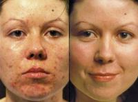 Gyógynövényes mélyhámlasztás eredményessége aknés bőr esetén