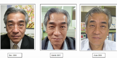 Mr. Suzuki átalakulás a 6 MyCells® kezelés után 4 és18 hónappal /www.my-cells.net/Dr. Livia Theodor/ MyCells®