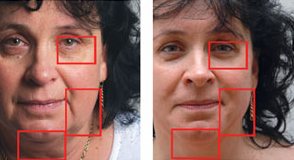 mezoterápiás arcfiatalítás (homlokráncok, orca, nevetőráncok, gravitációs mélyráncok) mezoterápiás arcfiatalítás (homlokráncok, orca, nevetőráncok, gravitációs mélyráncok)