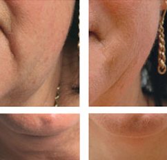 mezoterápiás arcfiatalítás és alakformálás (lipolízis: pl. tokacsinosítás)