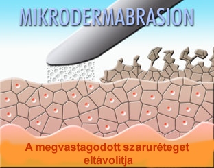 mikrodermabrázió folyamata