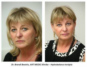 Hydrobalance terápia látványos eredménye az arcon és az ajkakon / Dr. Brandl Beatrix