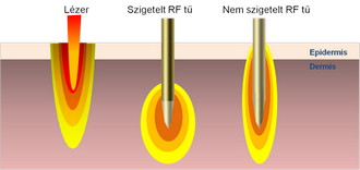 Frakcionált, mikrotűs, rádiófrekvenciás kezelés legújabb módszere már hazánkban is elérhető- VIVACE 2.kep