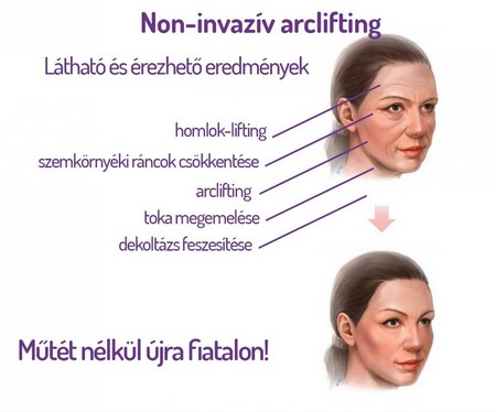 Arclifting mikrofókuszált ultrahanggal - UTIMS HIFU 3.kep