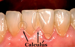 Fogkő - sárgás lerakódás a fog-íny találkozásánál és a fogak között