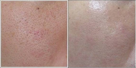 Pórusos bőr javulása a VIVACE kezelés után