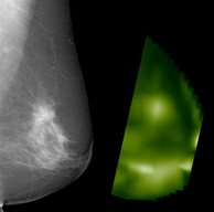 RTG és CT lézeres mammográfiás kép 60 éves páciens bal melléről: invasive ductal carcinoma 