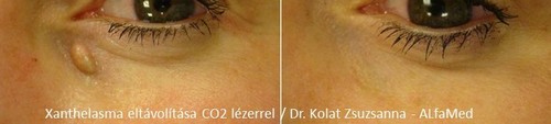 Milium CO-2 lézeres eltávolításának eredményessége Milium CO-2 lézeres eltávolításának eredményessége