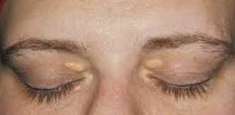 Xanthelasma Xanthelasma