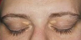 Xanthelasma