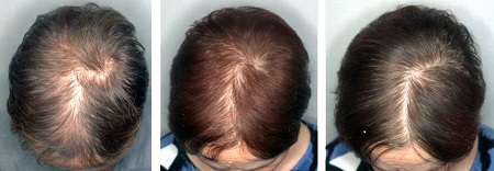 Demodex, a hajhullást okozó szörtüszőatka vizsgálata és kezelése 3.kep
