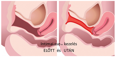 Hüvelyszűkítés műtét nélkül, IntimaLase-zel 3.kep