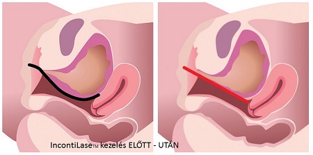 INKONTINENCIA megoldása műtét nélkül IncontiLase lézerterápiával 3.kep