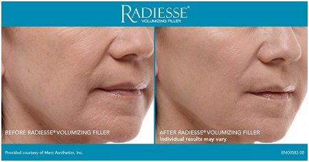 Radiesse eredményessége nasolabiális és szájzug régió kezelésénél/Merz Aesthetic Radiesse eredményessége nasolabiális és szájzug régió kezelésénél/Merz Aesthetic