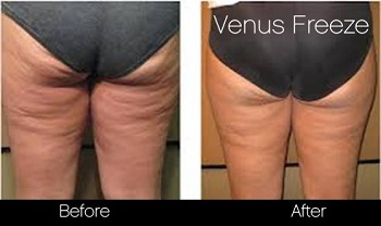 Venus Freeze alkalmas körfogat és a cellulit csökkentésre- ált. 6-12 alkalom kell ezekhez az eredményekhez/ SpaMedica Venus Freeze alkalmas körfogat és a cellulit csökkentésre- ált. 6-12 alkalom kell ezekhez az eredményekhez/ SpaMedica
