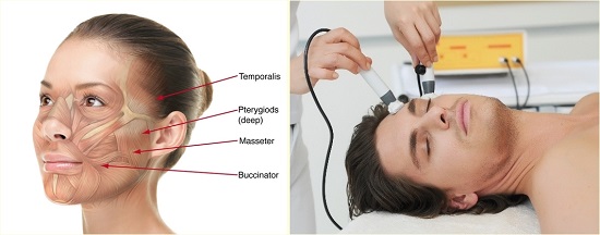 BEAUTYSTIMM bipoláris elektrostimuláció kezelési pontjai BEAUTYSTIMM bipoláris elektrostimuláció kezelési pontjai