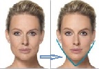 Műtétmentes arcemelés, arckontúr javítás és bőrmegújulás 50+ 1.kep