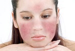 Rosacea az arcon Rosacea az arcon