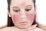 Rosacea az arcon