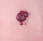 Haemangioma Haemangioma