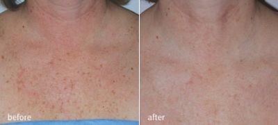 Dekoltázs bőrének rejuvenálása - depigmentálás, bőrfelszín javítás elos Plus SR/ SRA-val