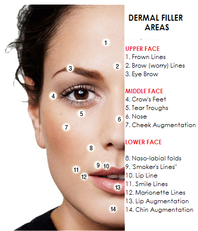 30+-os nő arcfiatalítása különböző keresztkötött hyaluronsav készítmények kombinálásval