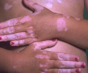 Vitiligo / pigmenthiány kezelése 1.kep