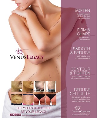 Venus Legacy 4D – Forradalmi újítás az alakformálás orvos-esztétikai piacán 3.kep