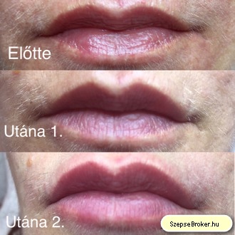 Duo-Ajakfiatalítás 2 lépésben / MD Kollagén + HA + Kollagenstimuláló hatóanyagok Előtte, Utána 1. és 2. alk Duo-Ajakfiatalítás 2 lépésben / MD Kollagén + HA + Kollagenstimuláló hatóanyagok Előtte, Utána 1. és 2. alk