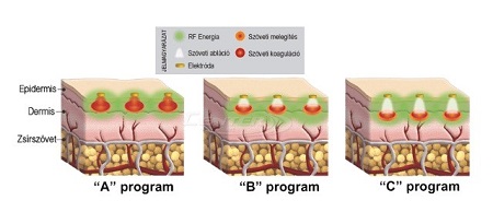 Duet RF- Frakcionált Thermal rádiófrekvenciás arcfiatalító eljárás 3.kep