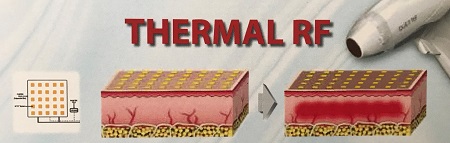 Duet RF- Frakcionált Thermal rádiófrekvenciás arcfiatalító eljárás 4.kep