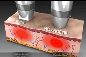 Frakcionált RF kezelés technológiája, thermikus hatás a bőr dermis rétegében
