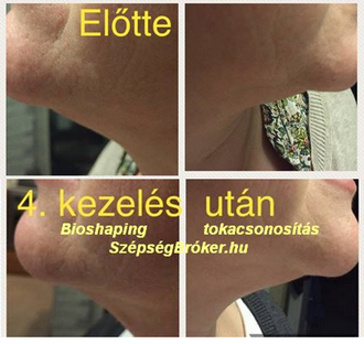 BIO-liplízis toka környékén kezelés előtt és a 4. zsíroldás után BIO-liplízis toka környékén kezelés előtt és a 4. zsíroldás után