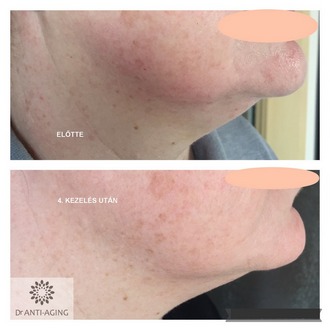 BIO-lipolysis + Cilvaris (UH, RF, EMS) gépi kezelés + Janssen Cosm. használata BIO-lipolysis + Cilvaris (UH, RF, EMS) gépi kezelés + Janssen Cosm. használata