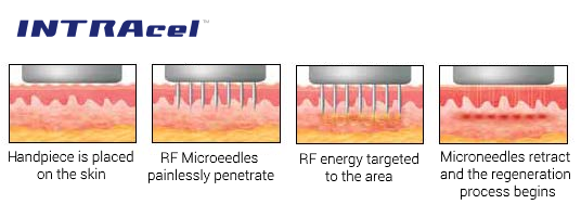 A világelső mikrotűs rádiófrekvenciás készülék, az INTRAcel PRO a bőrmegújítás szolgálatában 3.kep