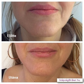 Biolifting - BioLipolízis kombinációja - előtte és a 3. alkalom után Biolifting - BioLipolízis kombinációja - előtte és a 3. alkalom után