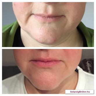 BioLipolízis - Biolifting kombinációja - előtte és az 5. alkalom után 1 héttel / Dr. Szabó Judit Anna BioLipolízis - Biolifting kombinációja - előtte és az 5. alkalom után 1 héttel / Dr. Szabó Judit Anna