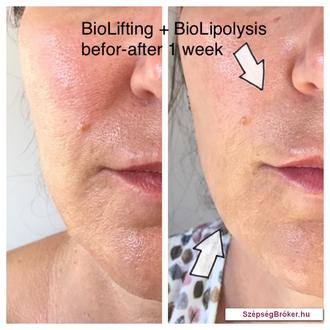 49 éves hölgy arcbőrének változása 1 alkalom kombinált Biolifting+ Biolipolysis kezelés hatására