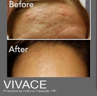 Vivace - mikrotűs rádiófrekvenciás arcfiatalító és bőrfeszesítő eljárás 5.kep