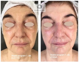 70+os hölgy egy alkalom Awake kezelési eredménye - mosolygós, életteli arc