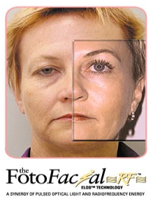 Teljes arcfiatalítás (felületes és mélyránc) érhető el az ELOS készülékekkel
